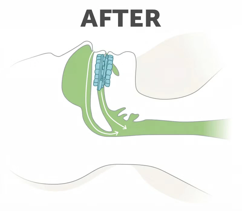 SnoreRx Mouthguard